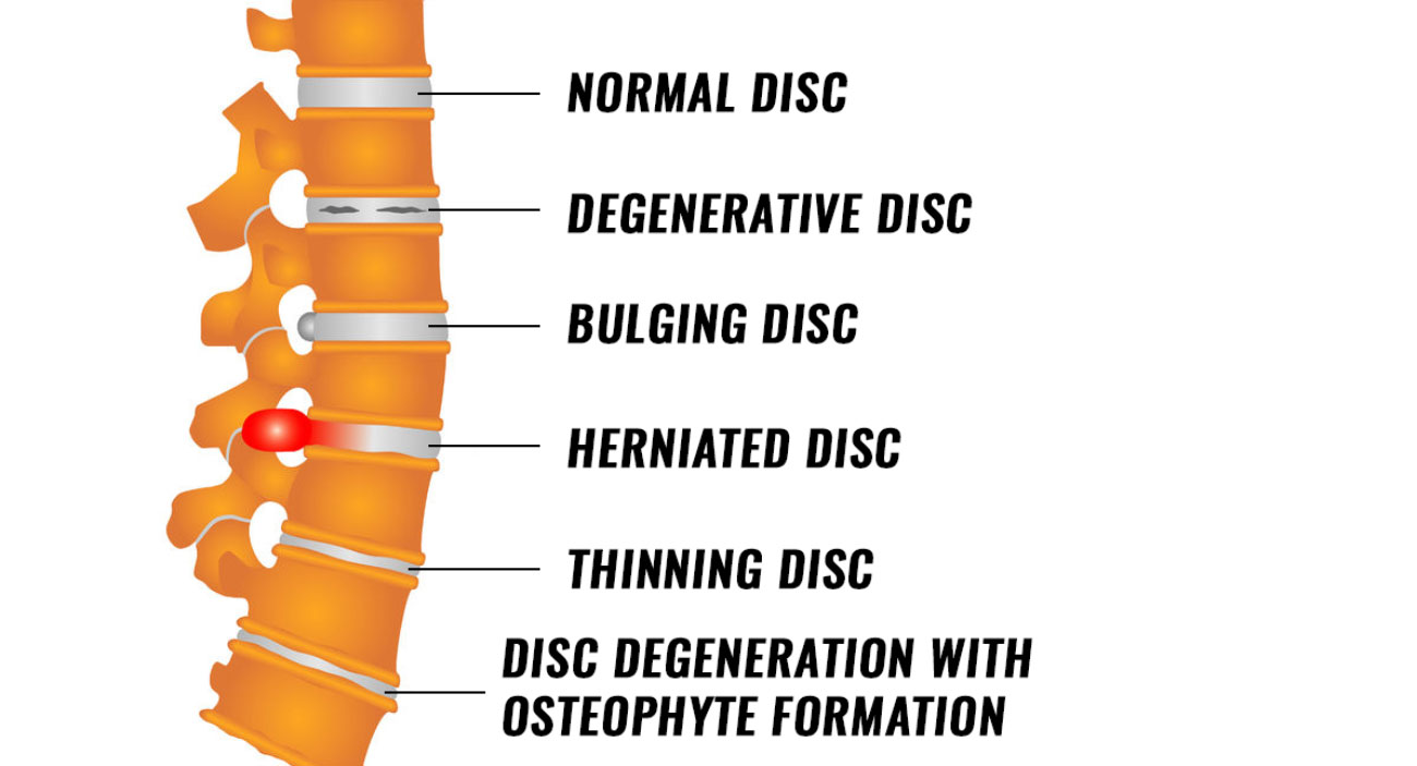 Diagram of spine and discs in varying stages of trauma.