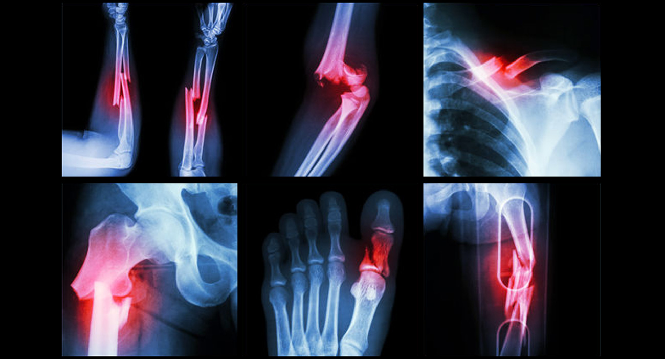 Multiple images of fractures in the body.