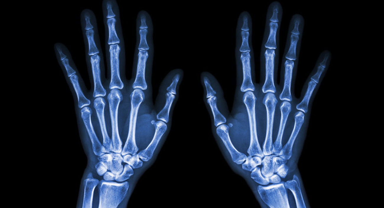 X-ray of two hands, showing bones.