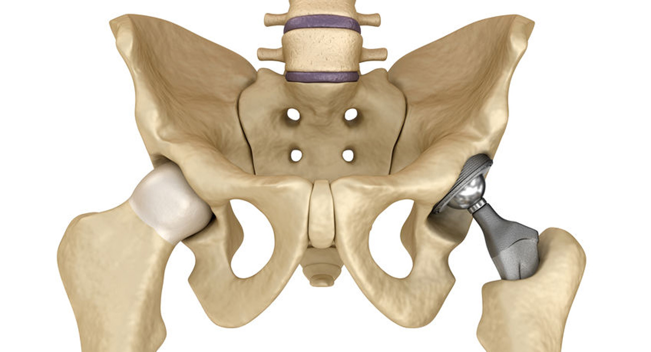 Skeleton showing a hip replacement joint.