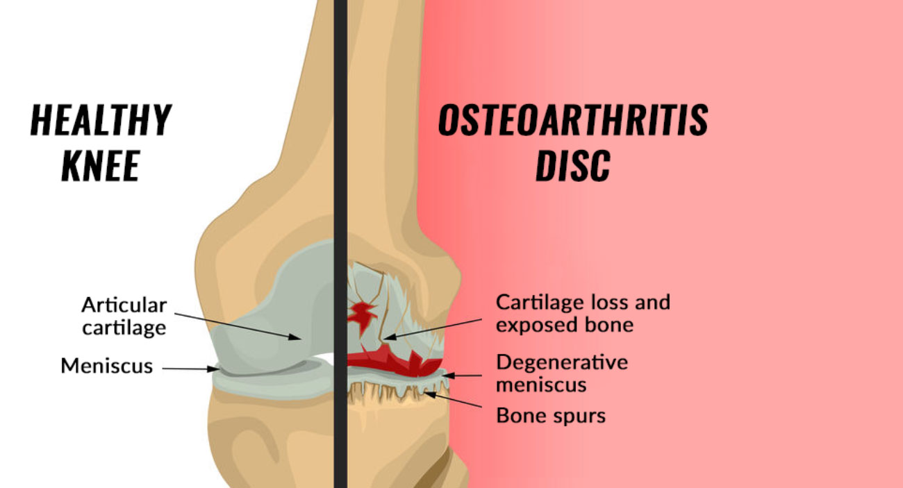 Diagram showing a Healthy Knee next to a knee with Osteoarthritis.