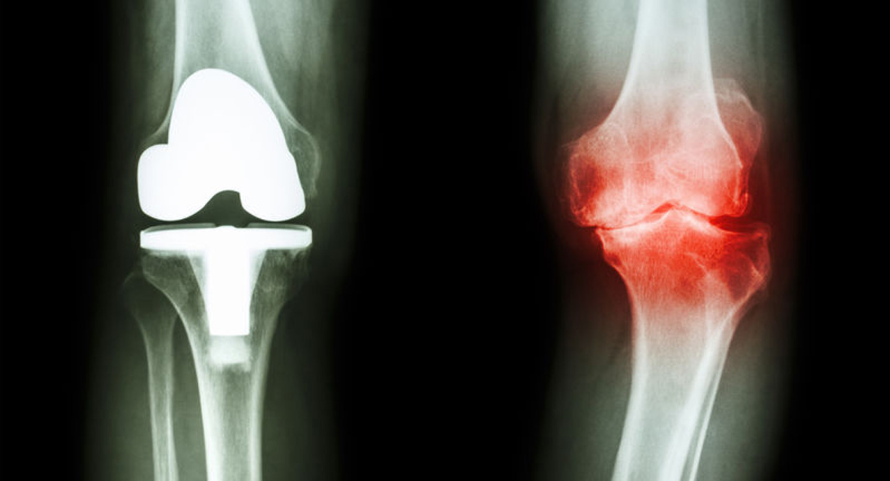 Image of an injured knee joint compared to a knee replacement.