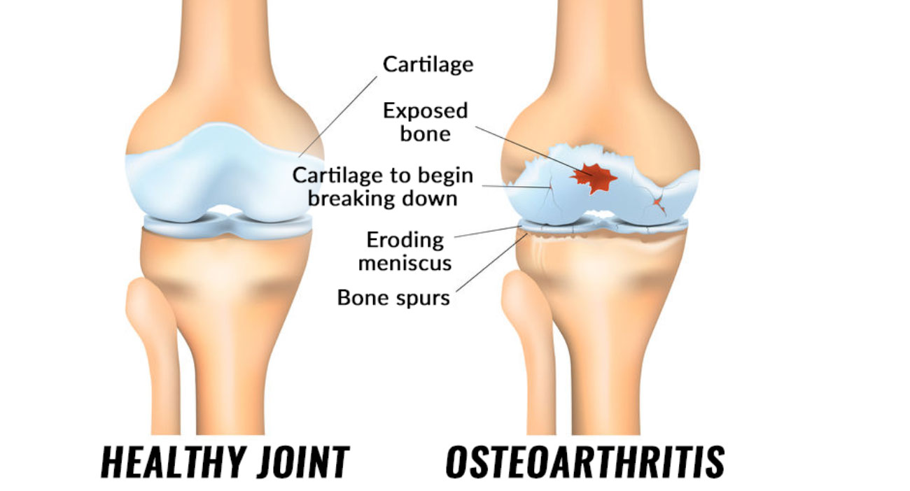 Osteoarthritis in the knee in comparison to a healthy knee