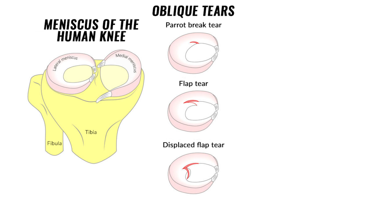 Diagram of knee with oblique meniscus tears.
